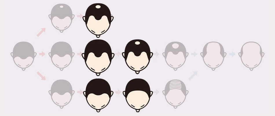 ハミルトン分類ー