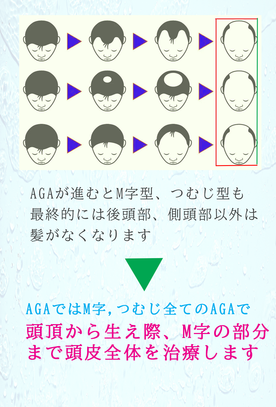 AGA治療ではM字はげもつむじ字はげも頭頂部から生え際までが治療の対象となります